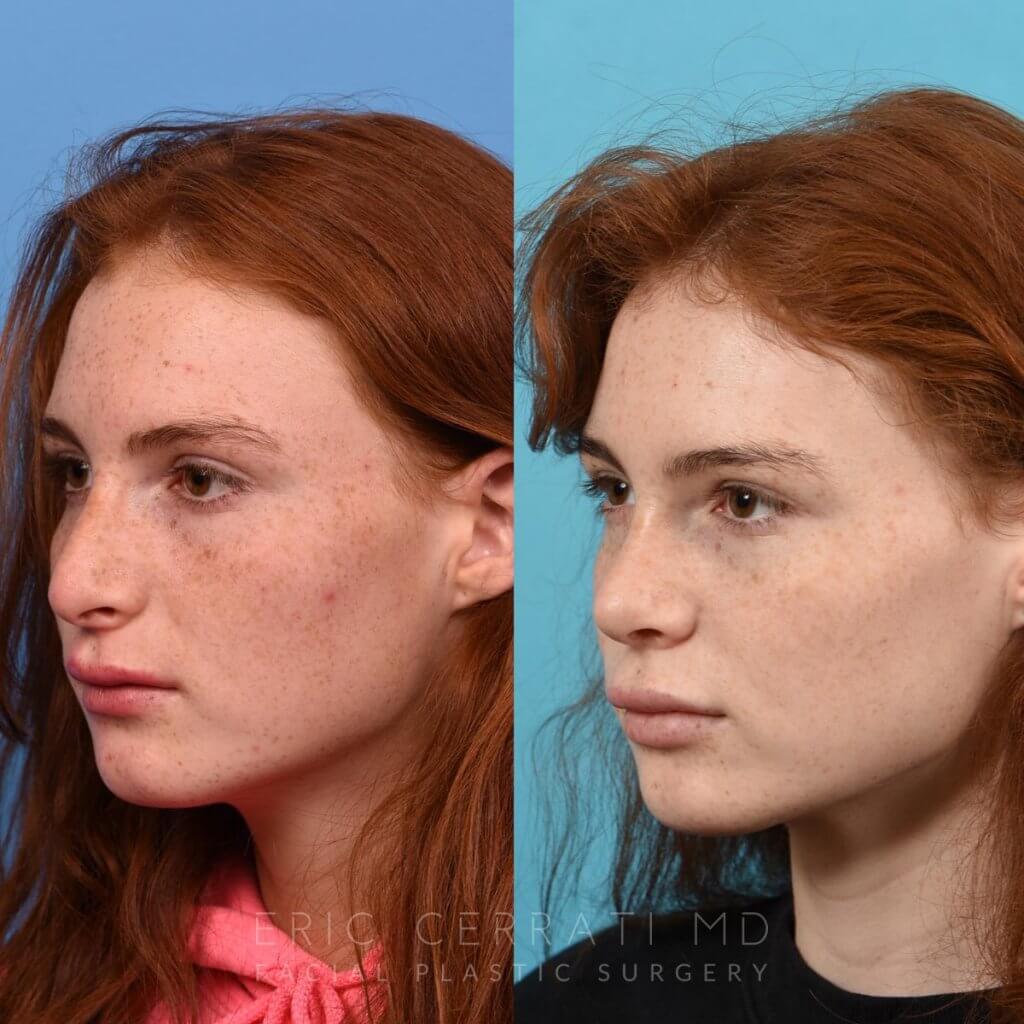 Female patient before and after rhinoplasty - left side.