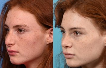 Female patient before and after rhinoplasty - left side.