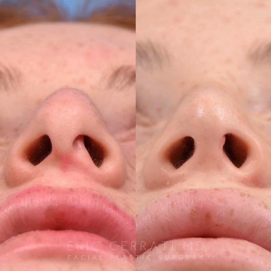 Female patient before and after rhinoplasty