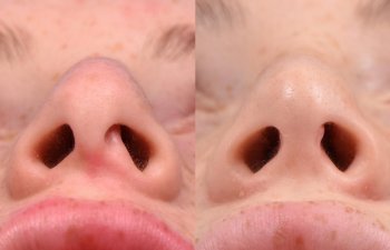 Female patient before and after rhinoplasty