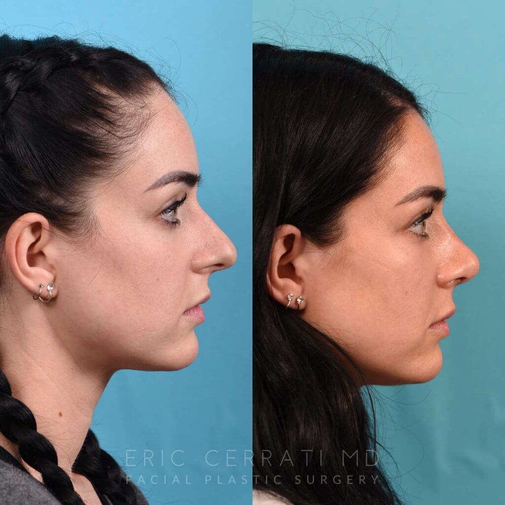 Female Patient Before and After Rhinoplasty