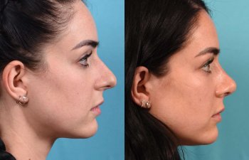 Female Patient Before and After Rhinoplasty