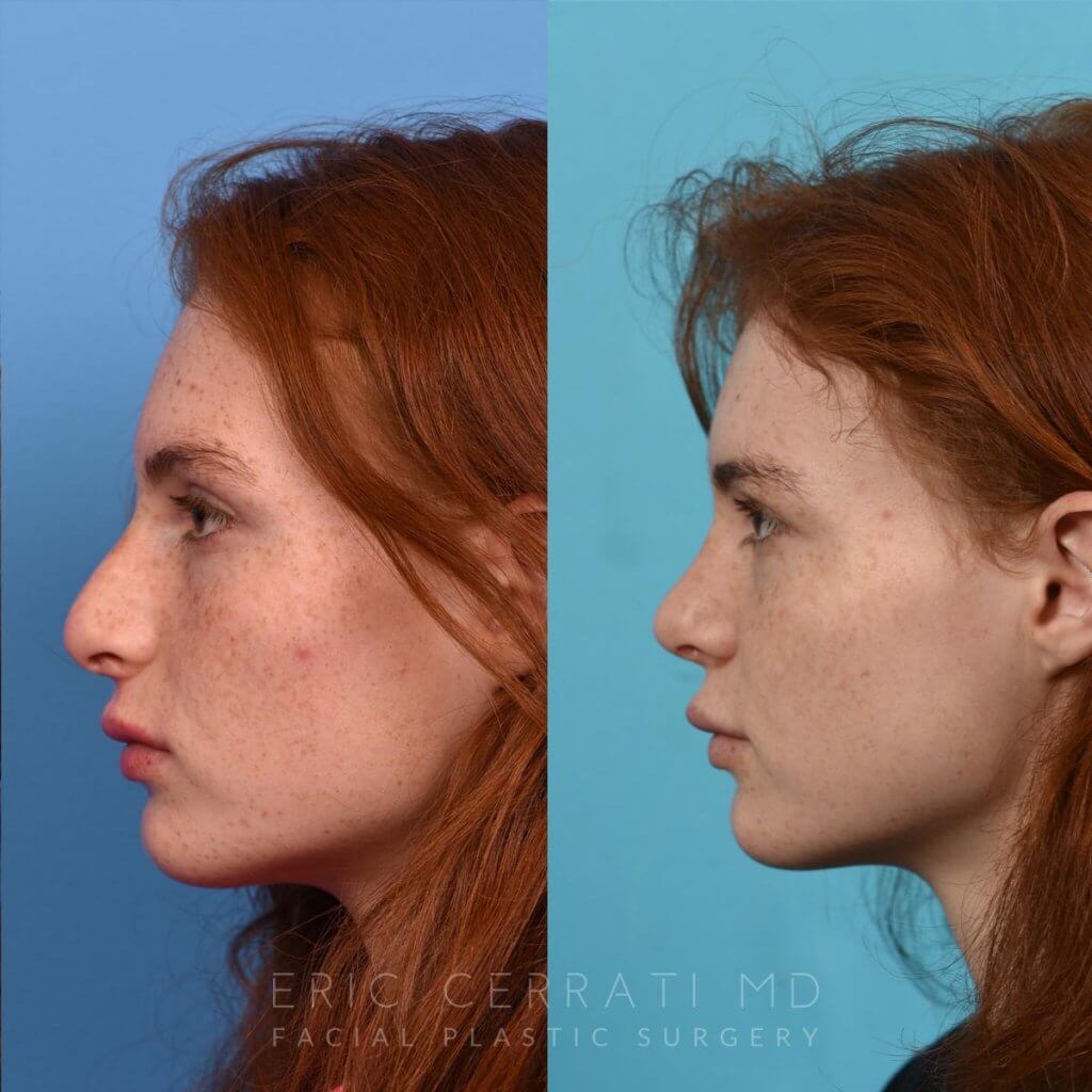 Female patient before and after rhinoplasty - left side.
