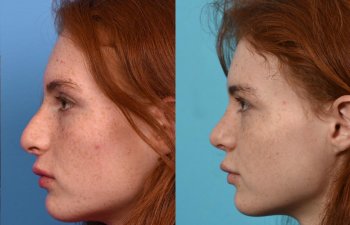 Female patient before and after rhinoplasty - left side.