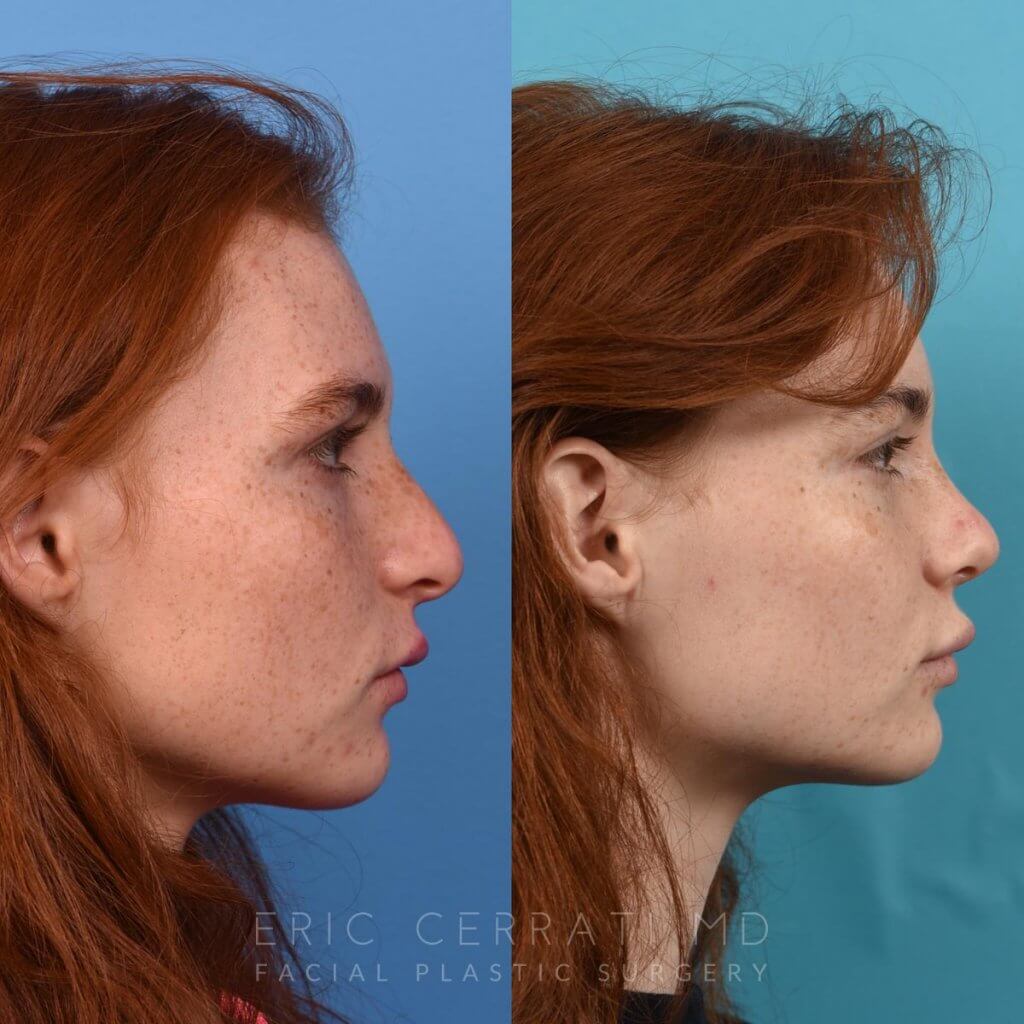 Female patient before and after rhinoplasty - right side.