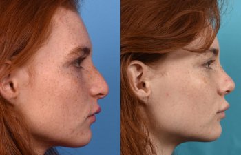 Female patient before and after rhinoplasty - right side.