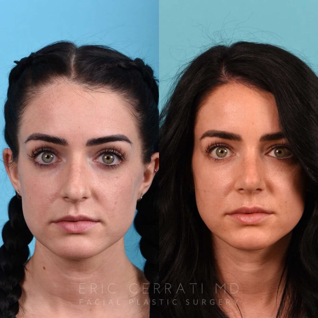 Female Patient Before and After Rhinoplasty