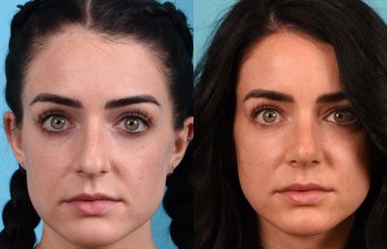 Female Patient Before and After Rhinoplasty
