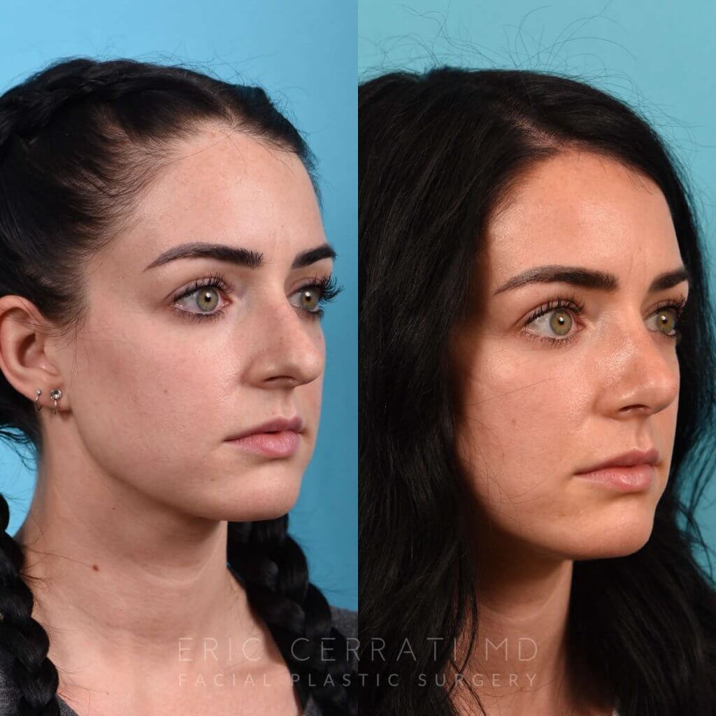 Female Patient Before and After Rhinoplasty