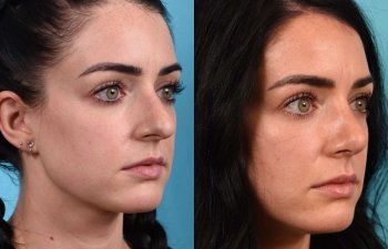 Female Patient Before and After Rhinoplasty