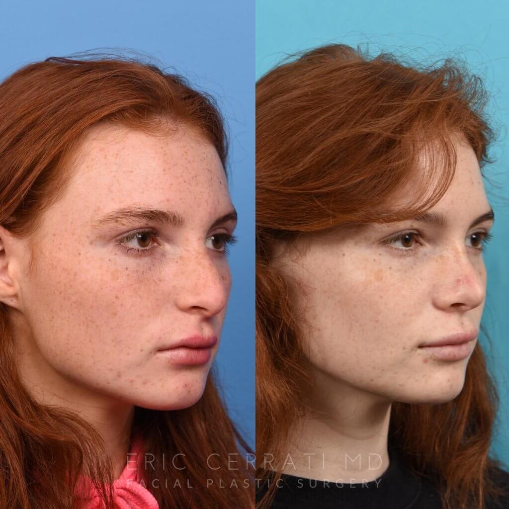 Female patient before and after rhinoplasty - right side.