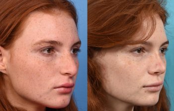 Female patient before and after rhinoplasty - right side.