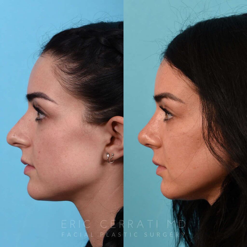 Female Patient Before and After Rhinoplasty