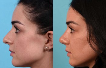 Female Patient Before and After Rhinoplasty