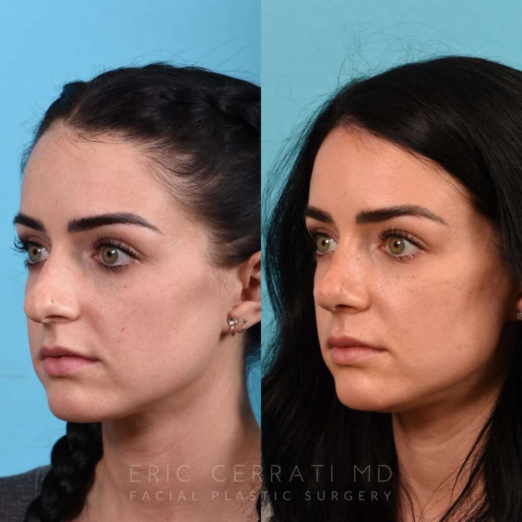 Female Patient Before and After Rhinoplasty