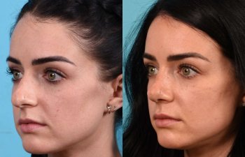 Female Patient Before and After Rhinoplasty