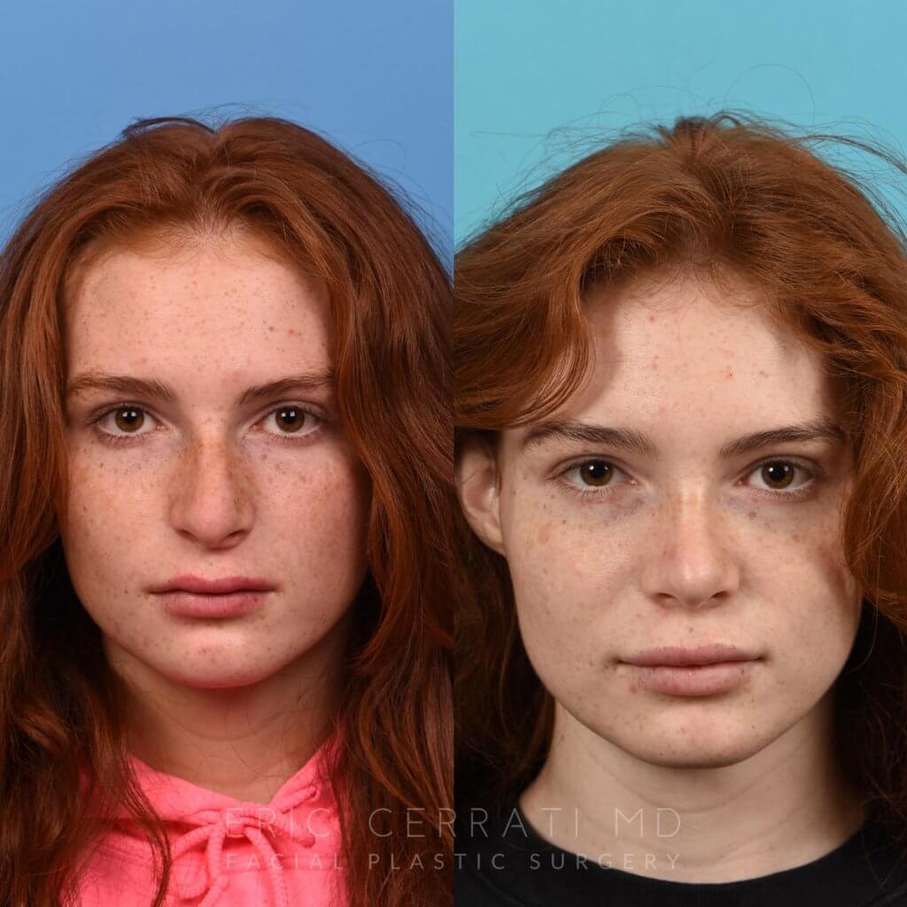 Female patient before and after rhinoplasty