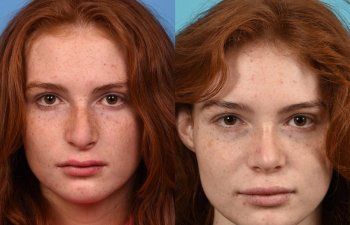 Female patient before and after rhinoplasty