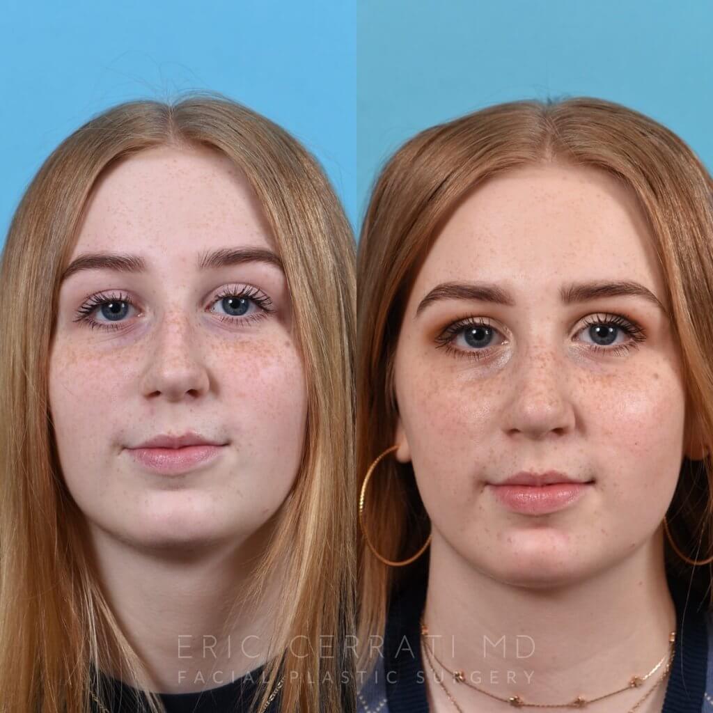 Female Patient Before and After Rhinoplasty