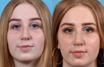 Female Patient Before and After Rhinoplasty