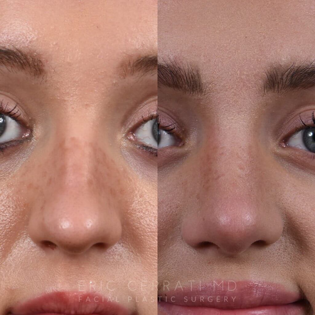 Female patient before and after rhinoplasty - front