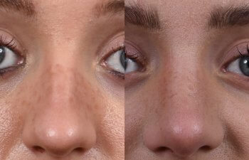 Female patient before and after rhinoplasty - front