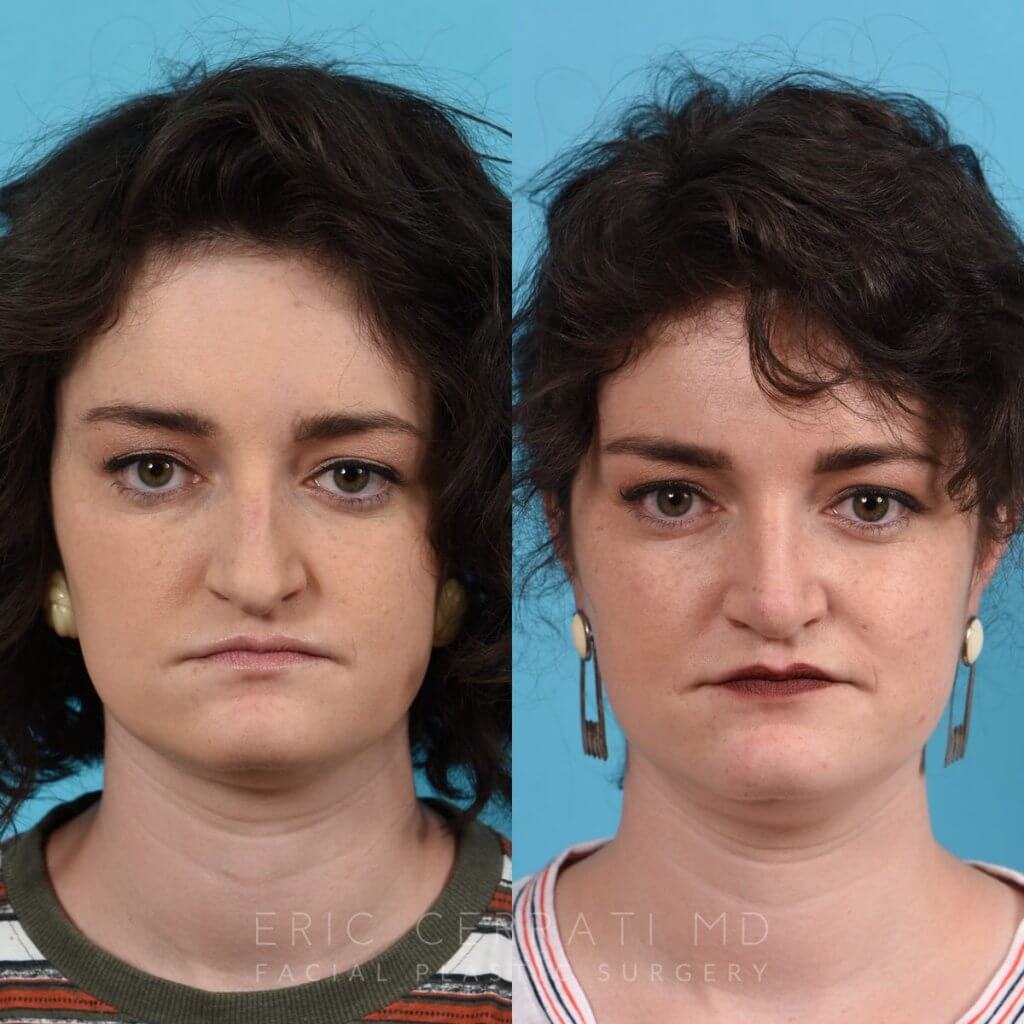 Female patient before and after rhinoplasty - front