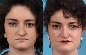 Female patient before and after rhinoplasty - front