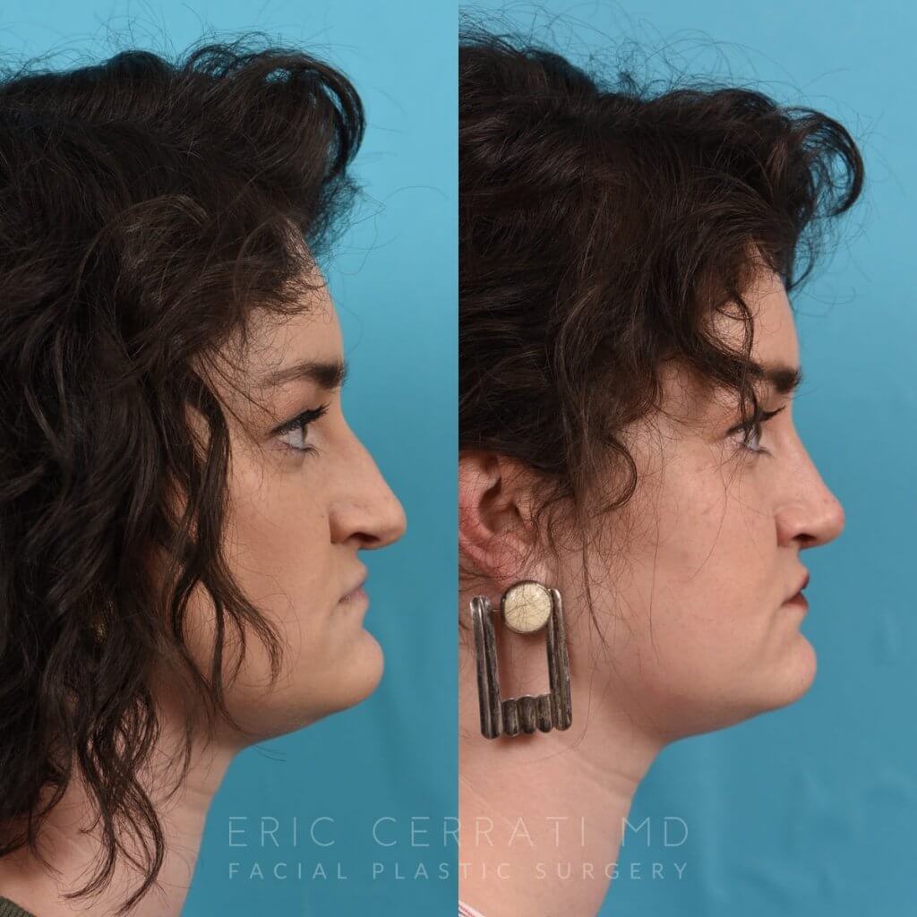 Female patient before and after rhinoplasty - right side