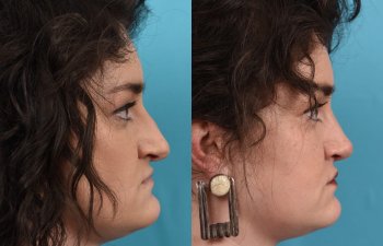 Female patient before and after rhinoplasty - right side