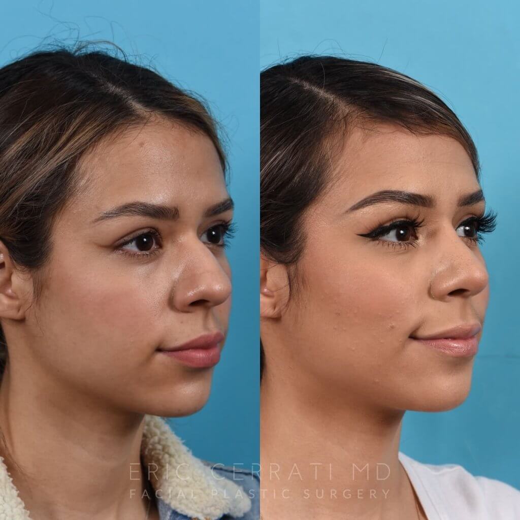 Female patient before and after rhinoplasty - right side