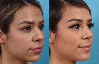 Female patient before and after rhinoplasty - right side