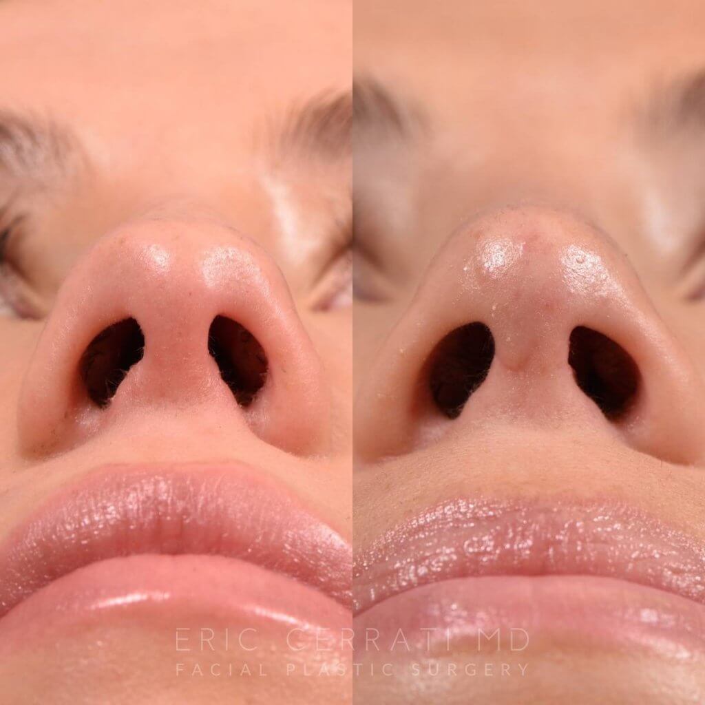 Female patient before and after rhinoplasty