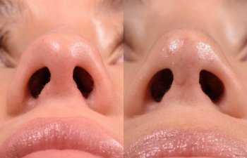 Female patient before and after rhinoplasty