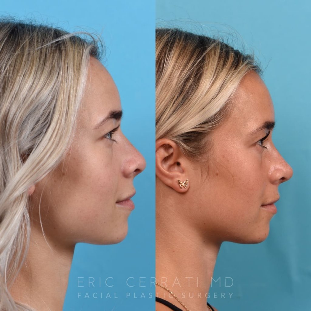 Female patient before and after rhinoplasty - right side