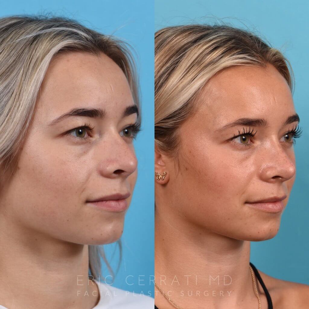 Female patient before and after rhinoplasty - right side
