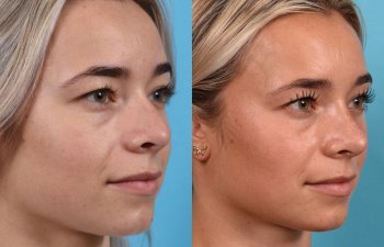 Female patient before and after rhinoplasty - right side