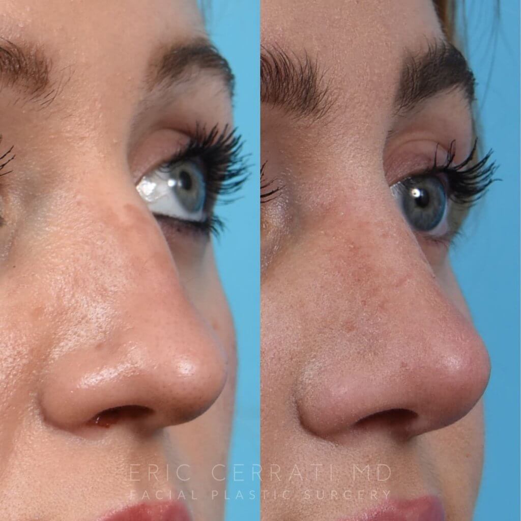 Female patient before and after rhinoplasty - right side