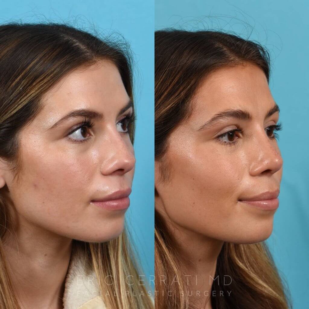 Female patient before and after rhinoplasty