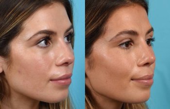 Female patient before and after rhinoplasty