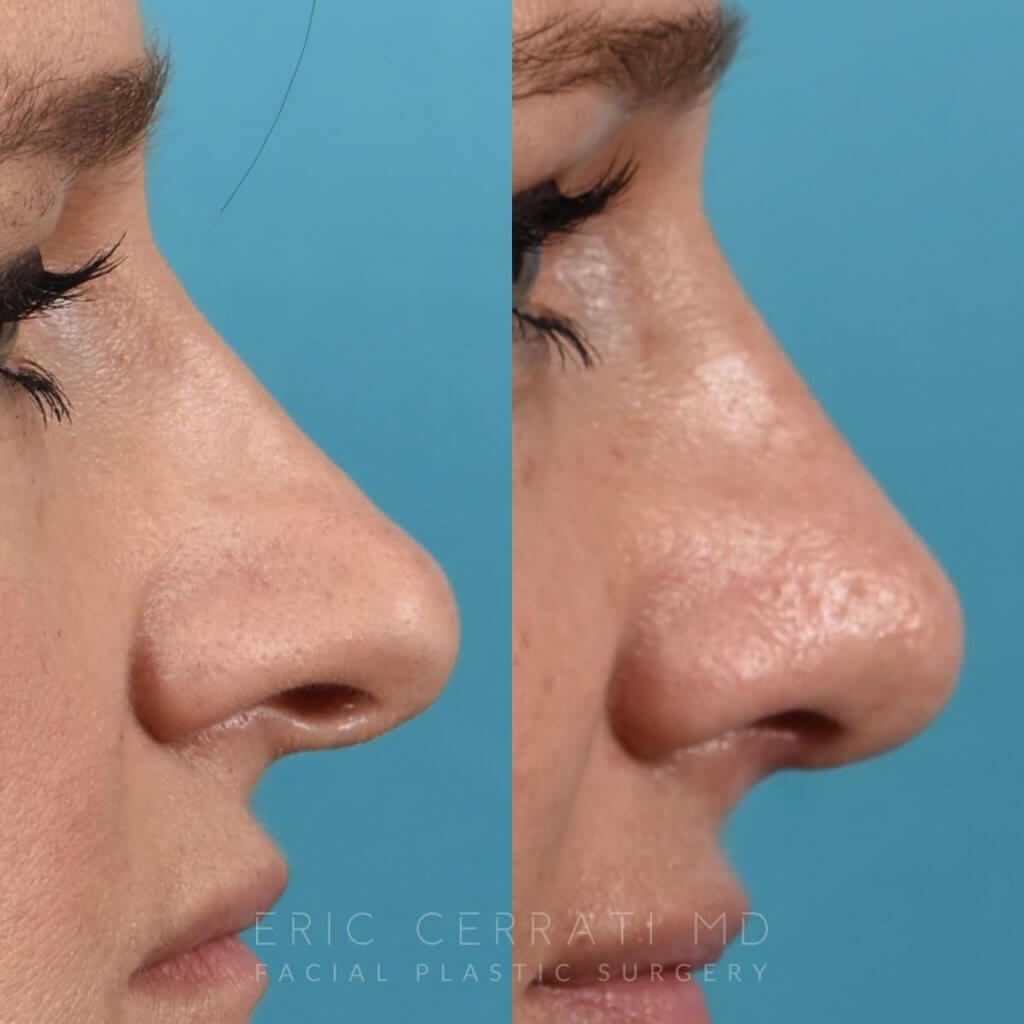 Female patient before and after rhinoplasty - right side