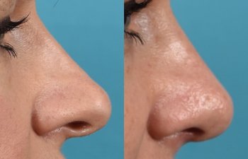 Female patient before and after rhinoplasty - right side
