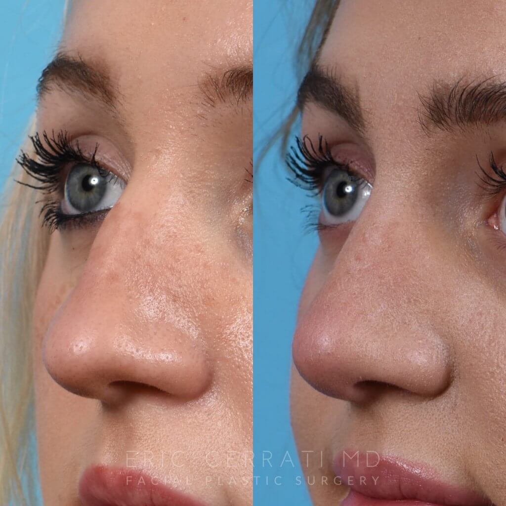 Female patient before and after rhinoplasty - left side