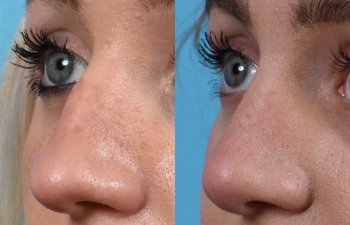 Female patient before and after rhinoplasty - left side