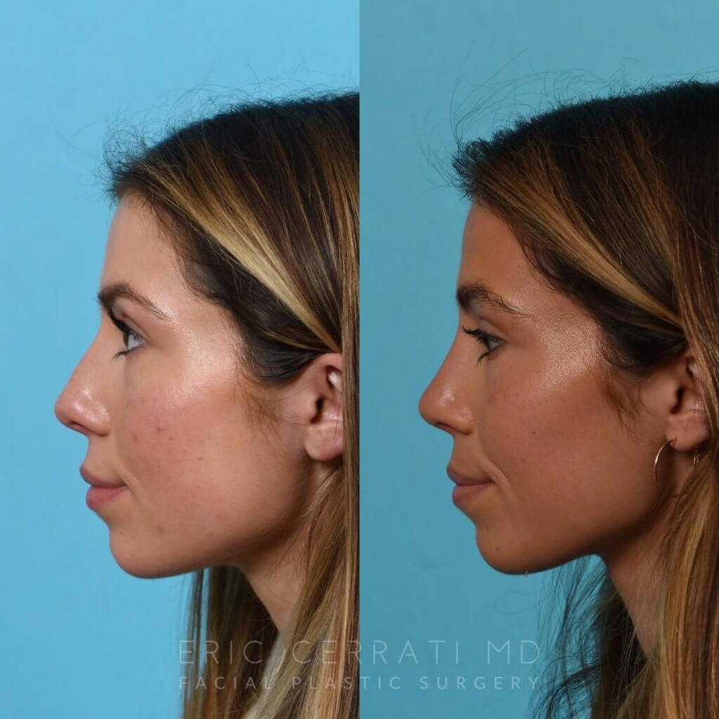 Female patient before and after rhinoplasty