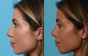 Female patient before and after rhinoplasty