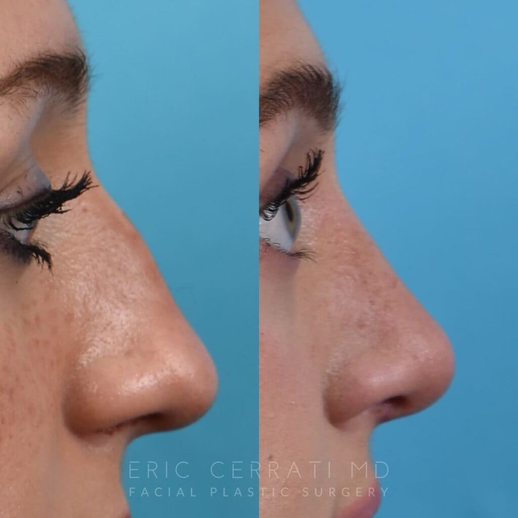 Female patient before and after rhinoplasty - right side