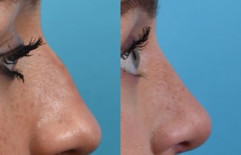 Female patient before and after rhinoplasty - right side