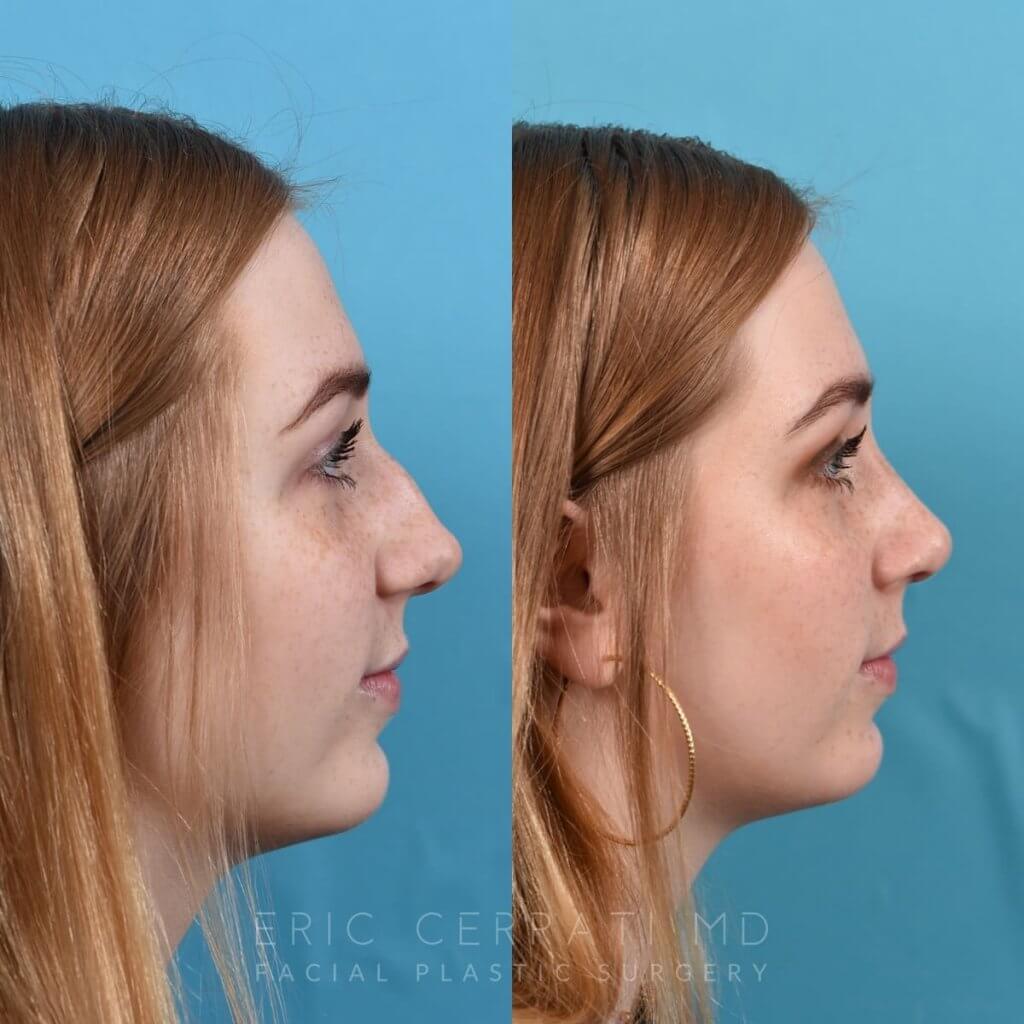 Female Patient Before and After Rhinoplasty