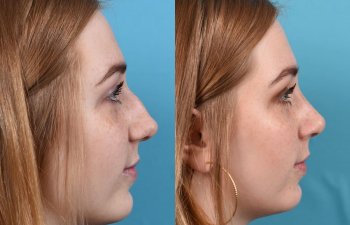 Female Patient Before and After Rhinoplasty